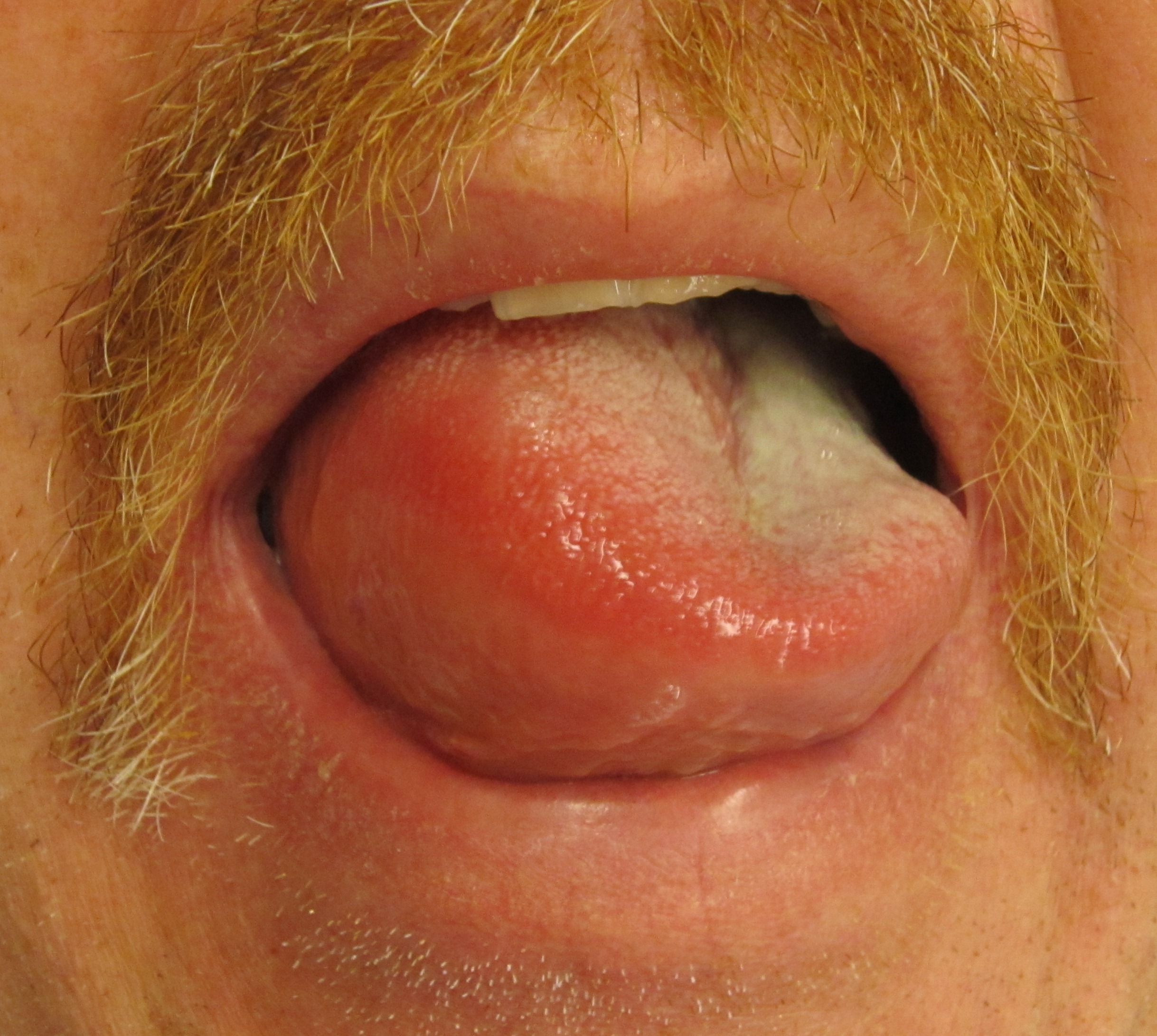 Severe angioedema of the tongue. This rapid fluid accumulation directly threatens airway patency, making immediate airway protection the highest clinical priority.
