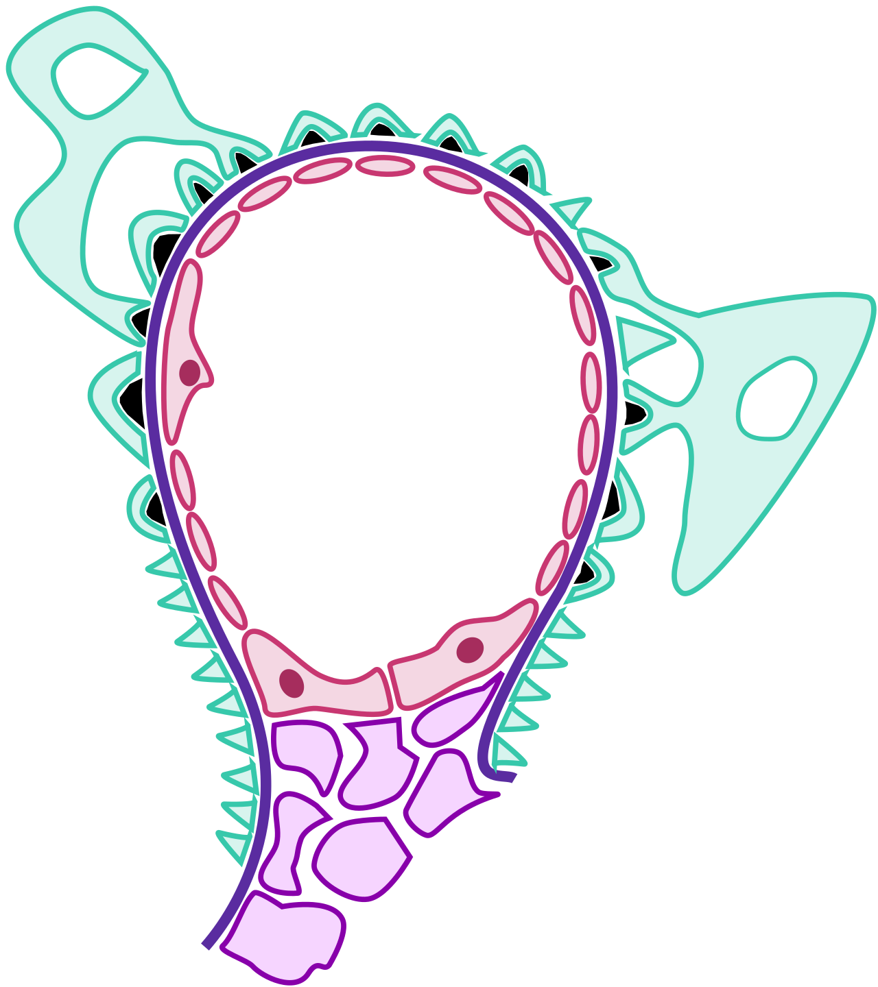 Pathology of acute glomerulonephritis. Immune complexes from a previous streptococcal infection accumulate in the kidney, clogging the glomerular filter and causing inflammation, hematuria, and edema.