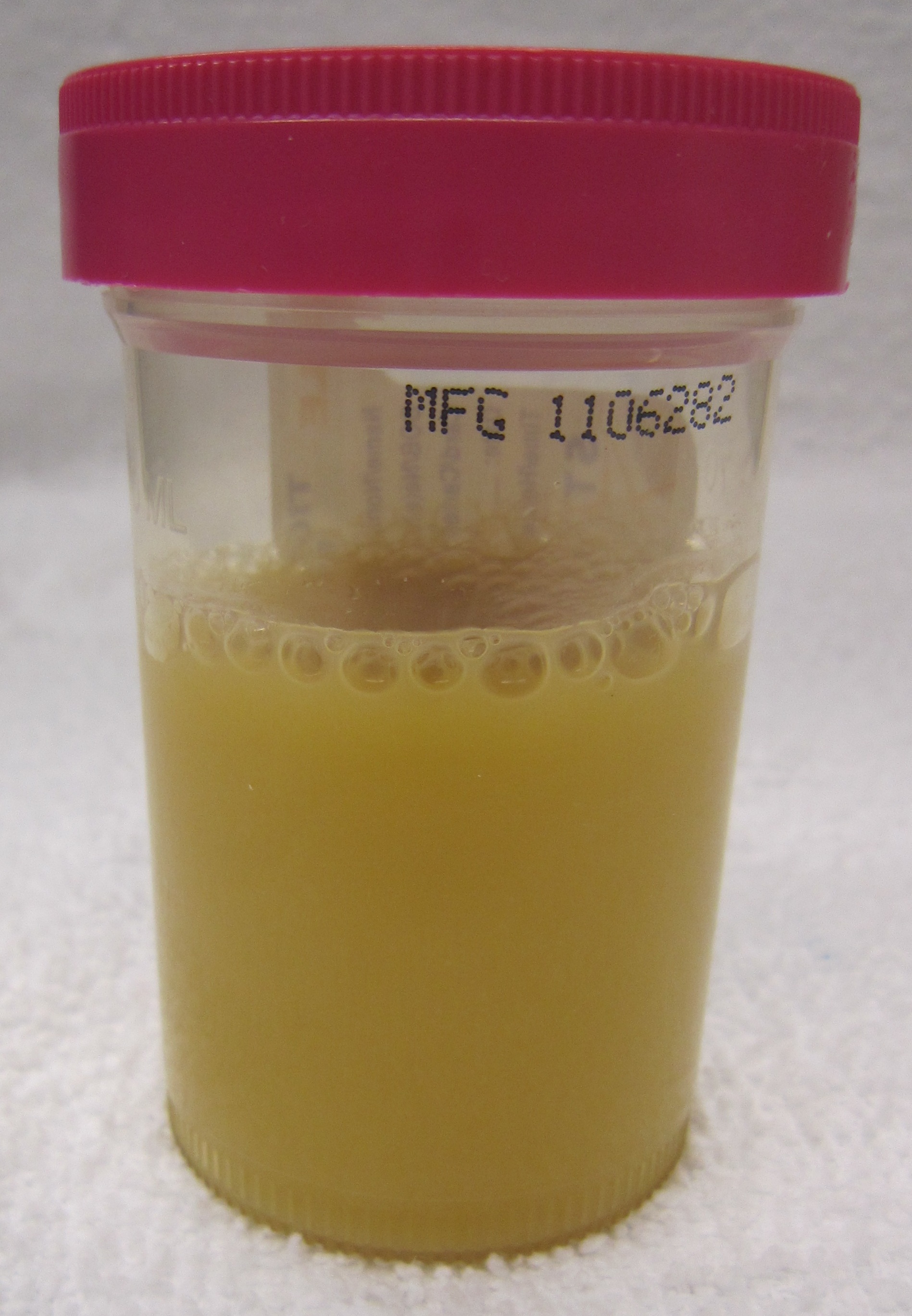 Cloudy, purulent urine (pyuria) is a classic visual indicator of a urinary tract infection.