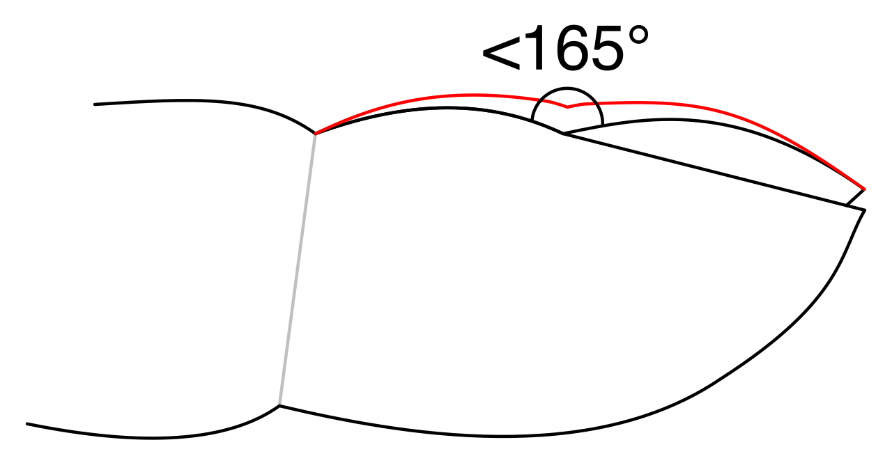 Nail clubbing involves a distinct change in the angle of the nail bed, serving as a classic clinical indicator of chronic systemic hypoxia.