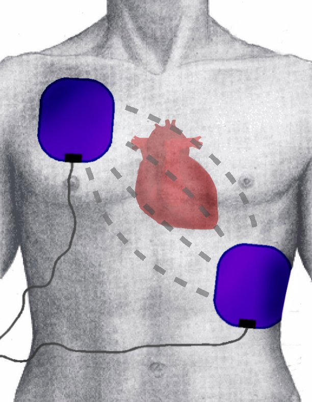 Standard anterior-apex placement of defibrillator pads, designed to direct the electrical shock straight through the myocardium to simultaneously depolarize the muscle tissue.