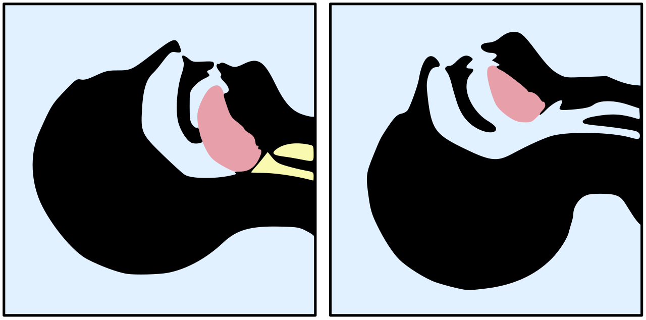 Proper airway positioning, such as the head-tilt/chin-lift maneuver, is a critical assessment step for clients presenting with severe central nervous system depression.