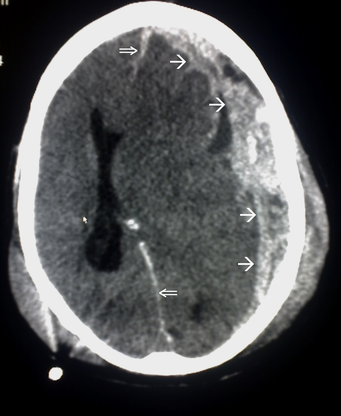 A CT scan showing a severe traumatic brain injury (subdural hematoma with midline shift). Patients with such profound neurological deficits lack the capacity to consent, requiring a healthcare proxy.