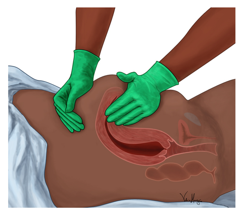 Anatomical side view demonstrating postpartum fundal massage, an essential mechanical intervention to stimulate uterine contraction and manage atony.