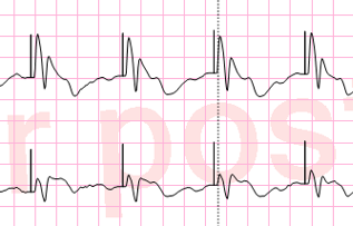 An electrocardiogram strip demonstrating true pacemaker capture, where each electrical pacing spike is successfully followed by a ventricular contraction.