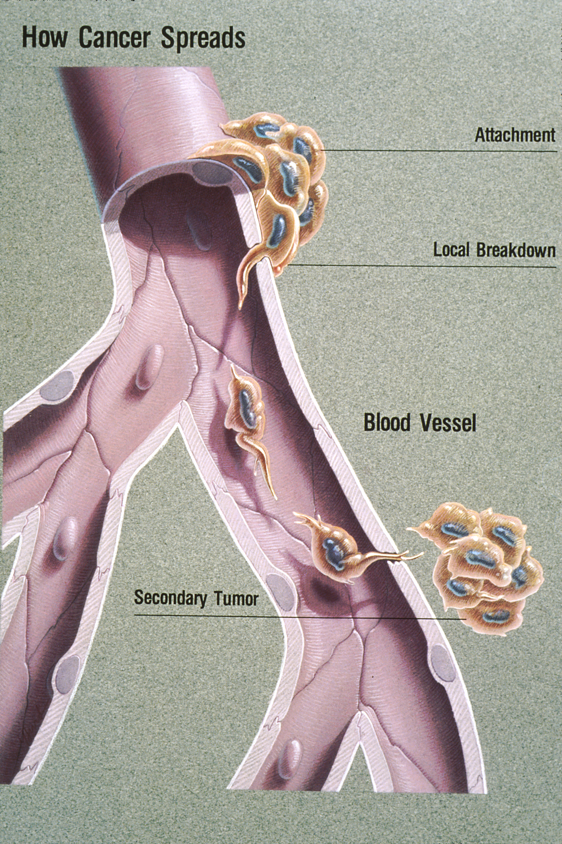 Metastasis occurs when malignant cells break away from the primary tumor mass and travel through the circulatory or lymphatic systems to establish secondary tumors in distant tissues.