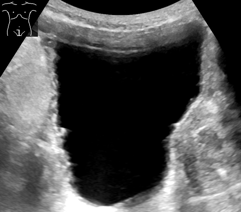 A non-invasive bladder ultrasound scan is the first-line intervention to objectively assess the volume of retained urine before resorting to invasive catheterization.