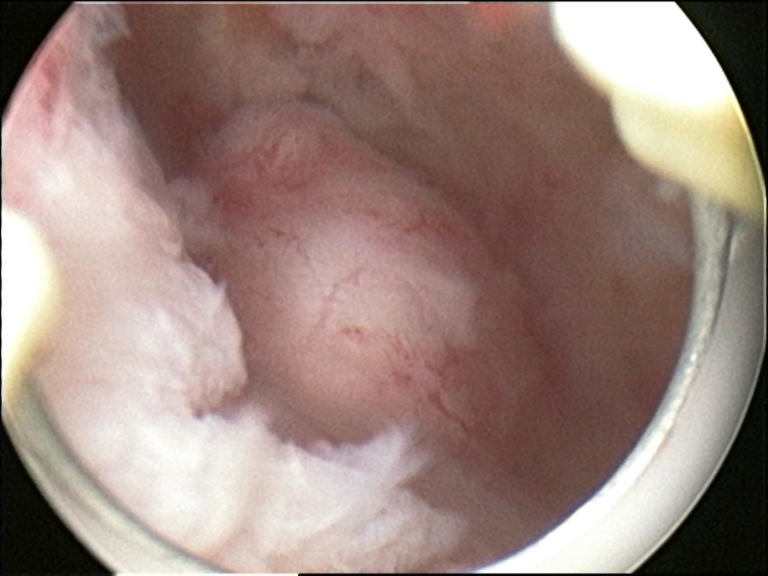 A hysteroscopic view from inside the uterine cavity revealing a submucosal uterine fibroid.