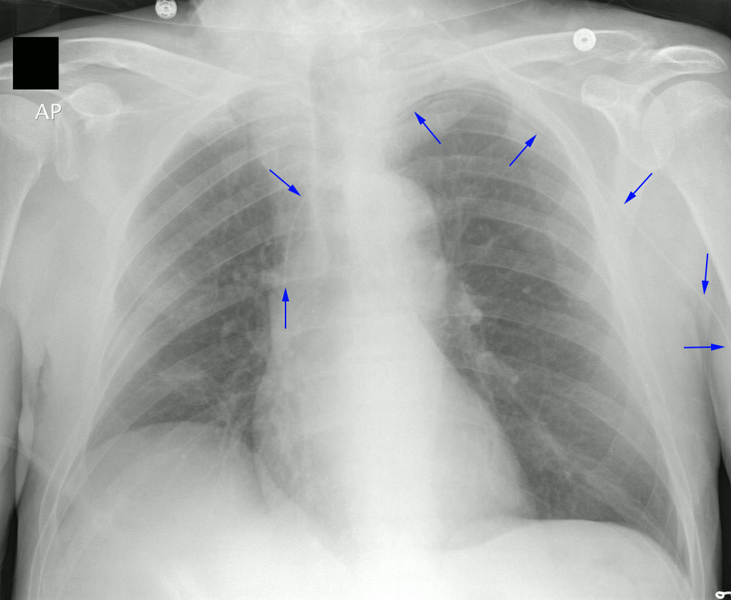 A chest radiograph verifying the correct placement of a PICC line, with the catheter tip safely resting in the large-volume superior vena cava.