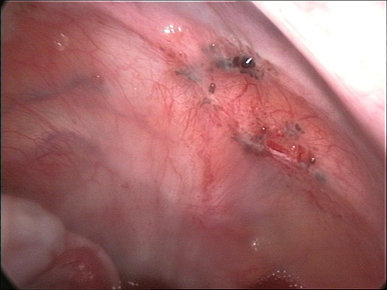 Laparoscopic view of ectopic endometriotic lesions attached to the peritoneum of the pelvic wall. These lesions bleed cyclically and lead to chronic inflammation.