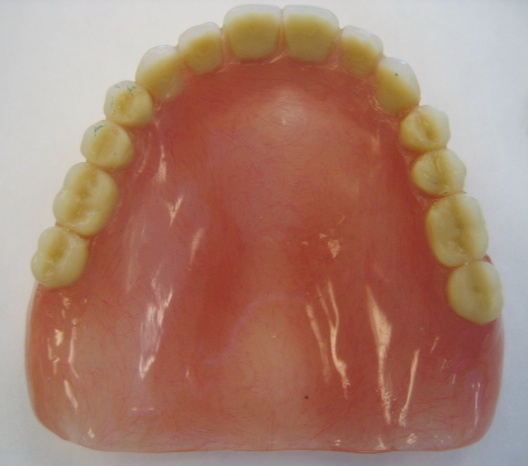 A maxillary denture. Because dentures are precisely engineered from acrylic polymers, they must be stored in water when removed from the mouth to prevent drying out and physical warping.