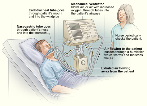 Mechanical ventilators apply positive pressure to force a higher concentration of oxygen gas to dissolve into a patient's liquid bloodstream, illustrating the effect of pressure on gas solubility.