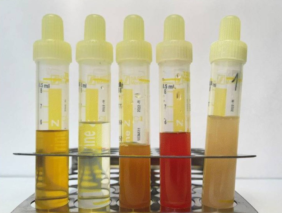 In clinical urinalysis, specific gravity measures the density of urine against pure water to assess how effectively the kidneys are concentrating waste.