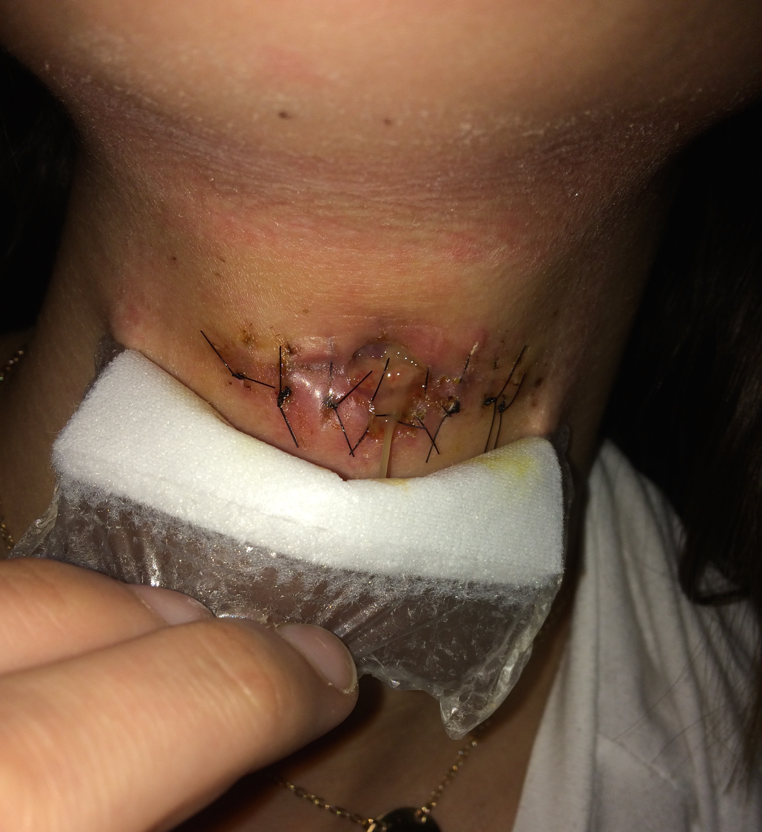 A surgical site infection demonstrating pronounced localized inflammation, redness, and swelling around the wound edges.