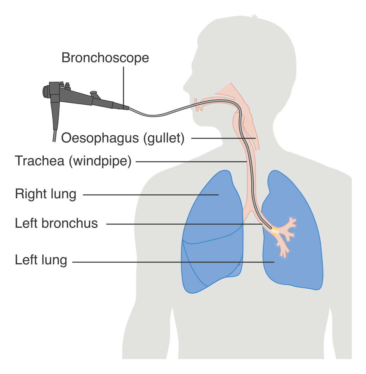 A bronchoscopy involves passing a camera down the throat and through the vocal cords, requiring a local anesthetic that temporarily disables the patient's protective gag reflex.