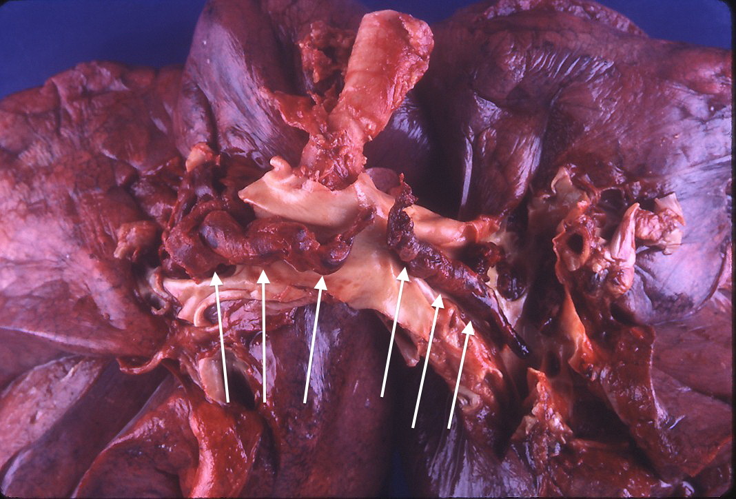 A pulmonary embolism, such as this massive saddle embolus obstructing the pulmonary artery, is an acute, unexpected complication that immediately threatens a patient's life and must be prioritized over expected, localized symptoms.