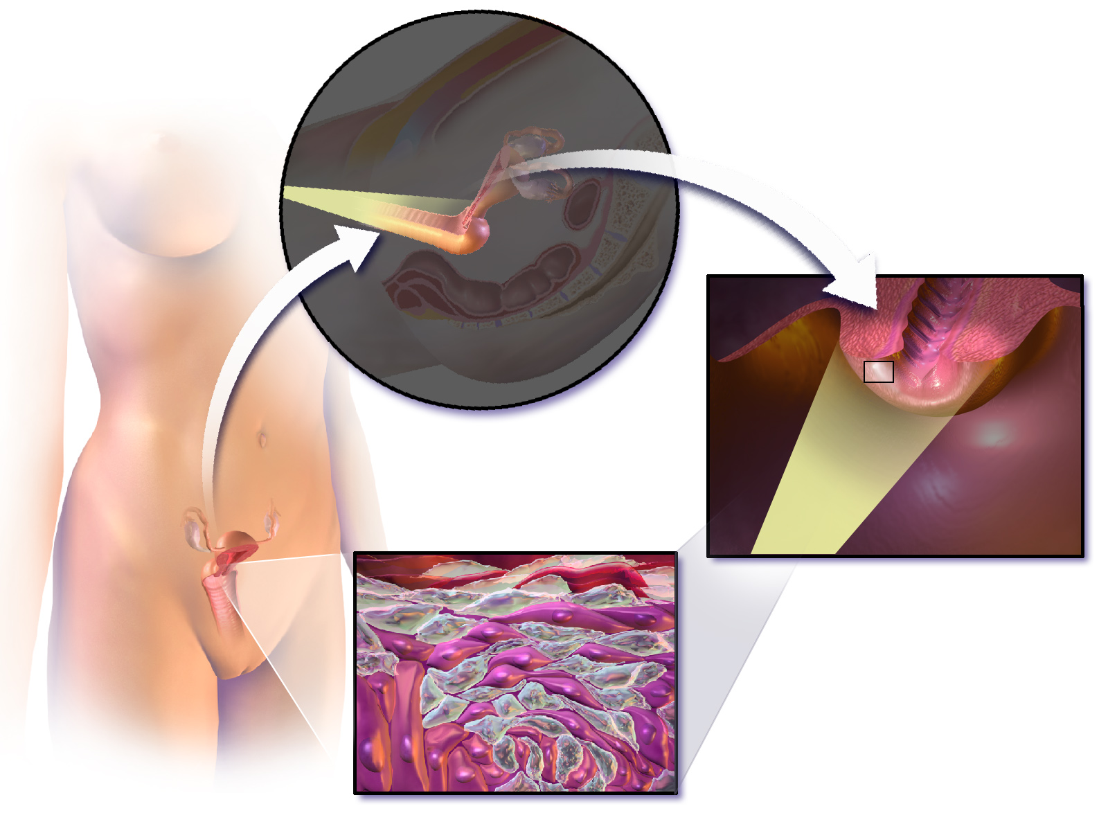 Schematic illustrating a colposcopy, which provides a magnified, illuminated view of the cervix to identify precancerous lesions.