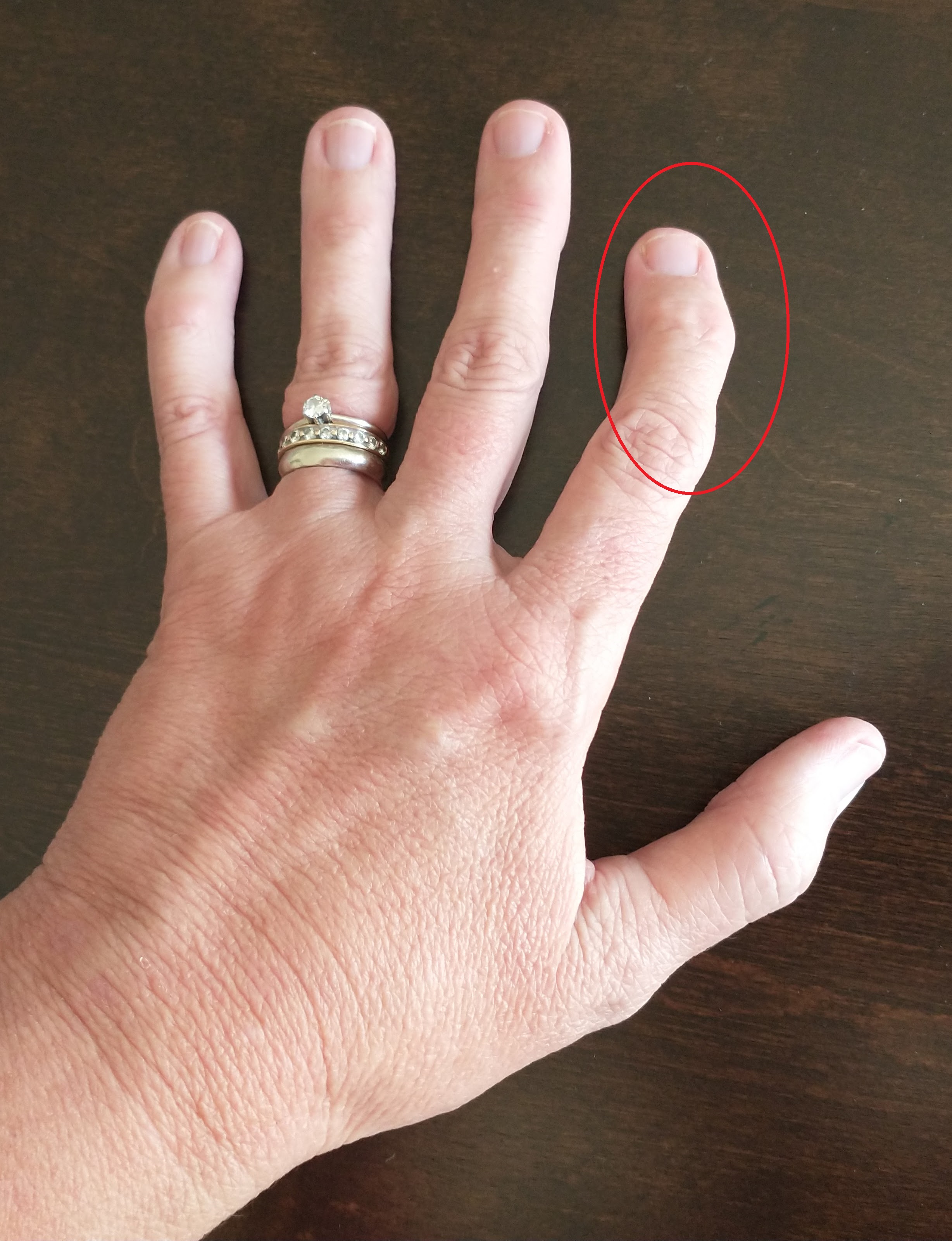 Severe joint deformities, such as osteoarthritis in the hands, significantly impair the fine motor skills required for foundational ADLs like dressing and feeding.