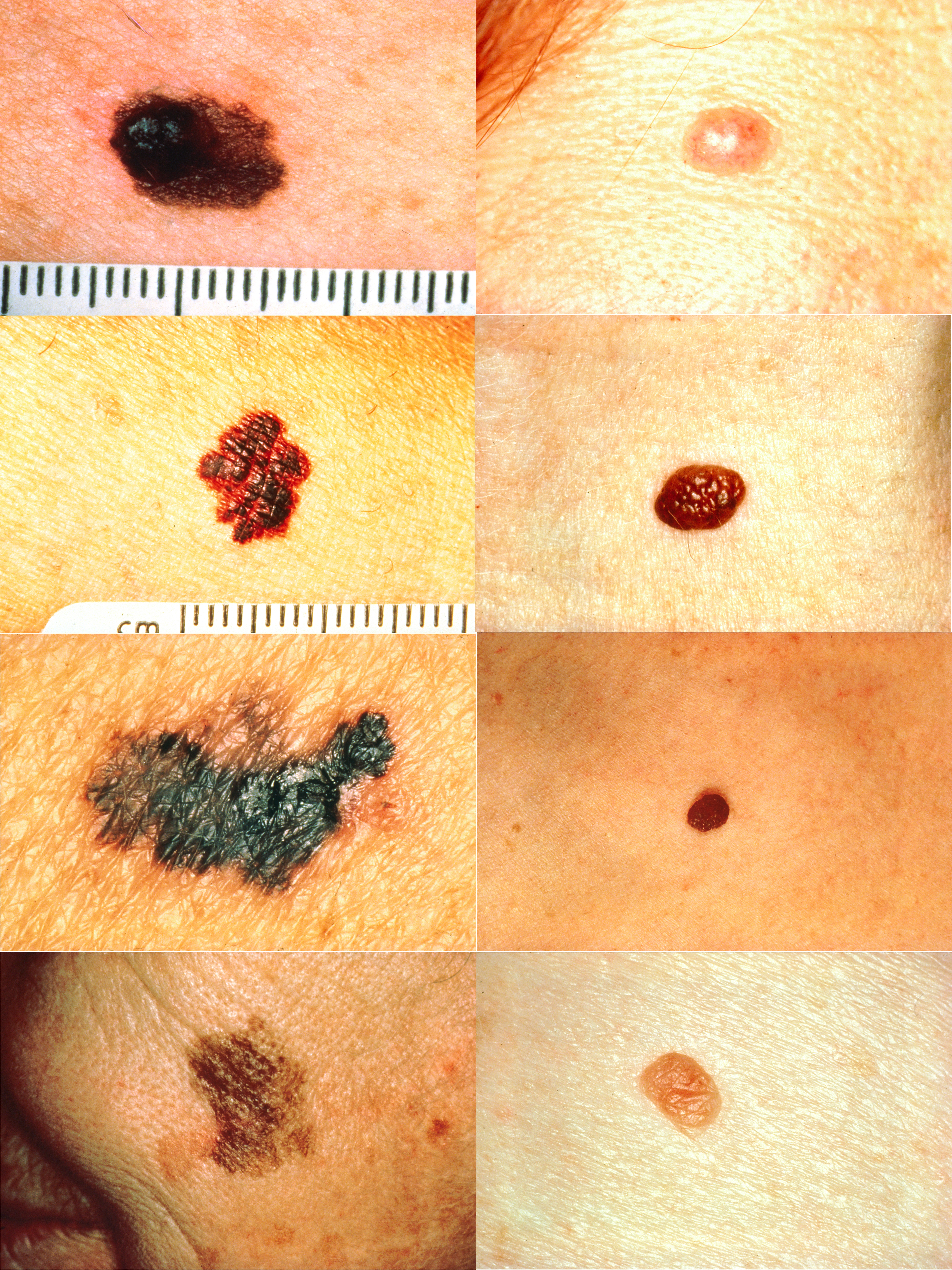 The ABCD rule visually outlines key characteristics of malignant melanomas (Asymmetry, Border irregularity, Color variation, and Diameter enlargement) compared to normal moles.