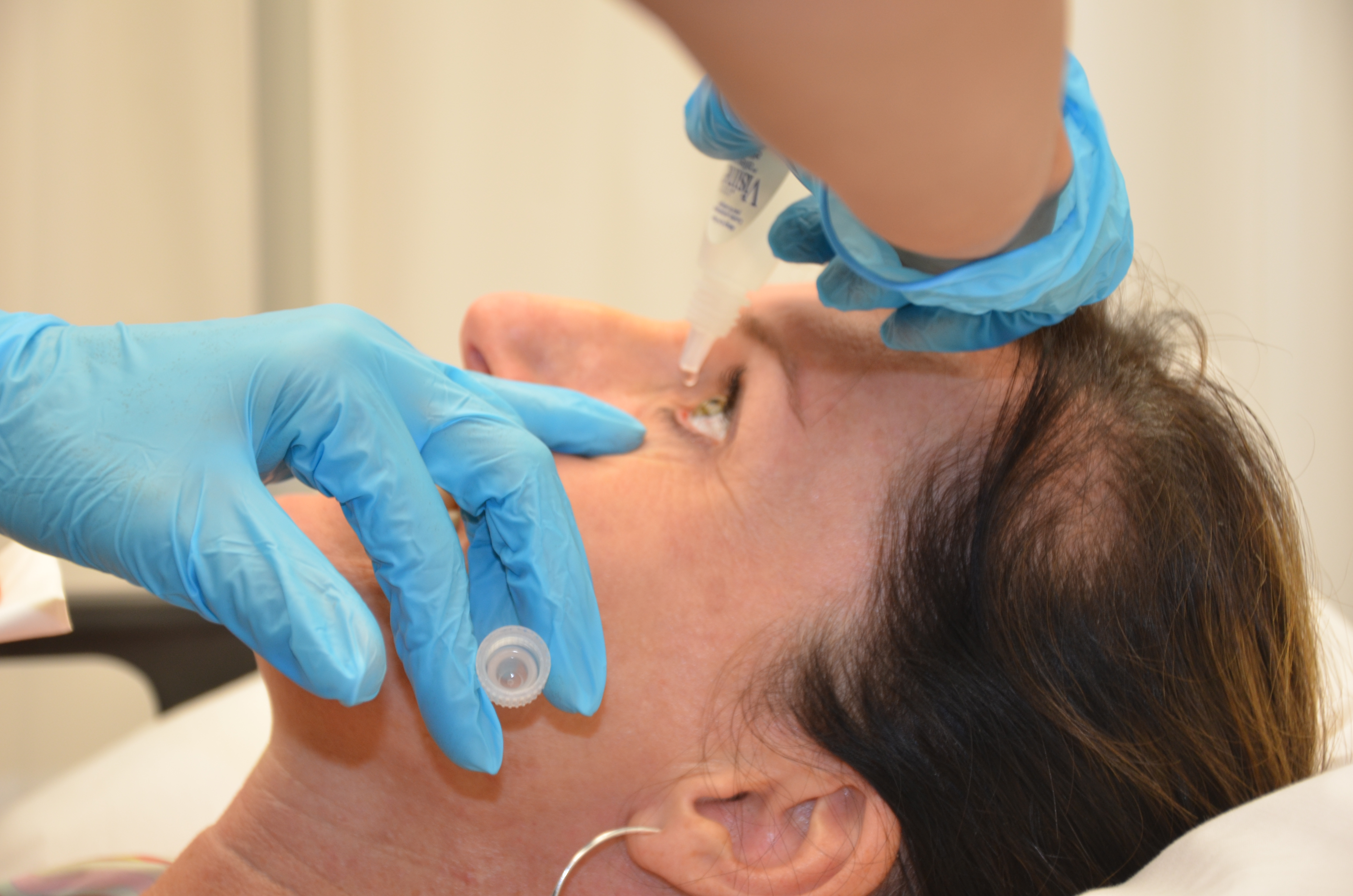 Proper instillation of ophthalmic drops into the lower conjunctival sac. Notice how the lower eyelid is pulled down to avoid dropping medication directly onto the sensitive cornea.