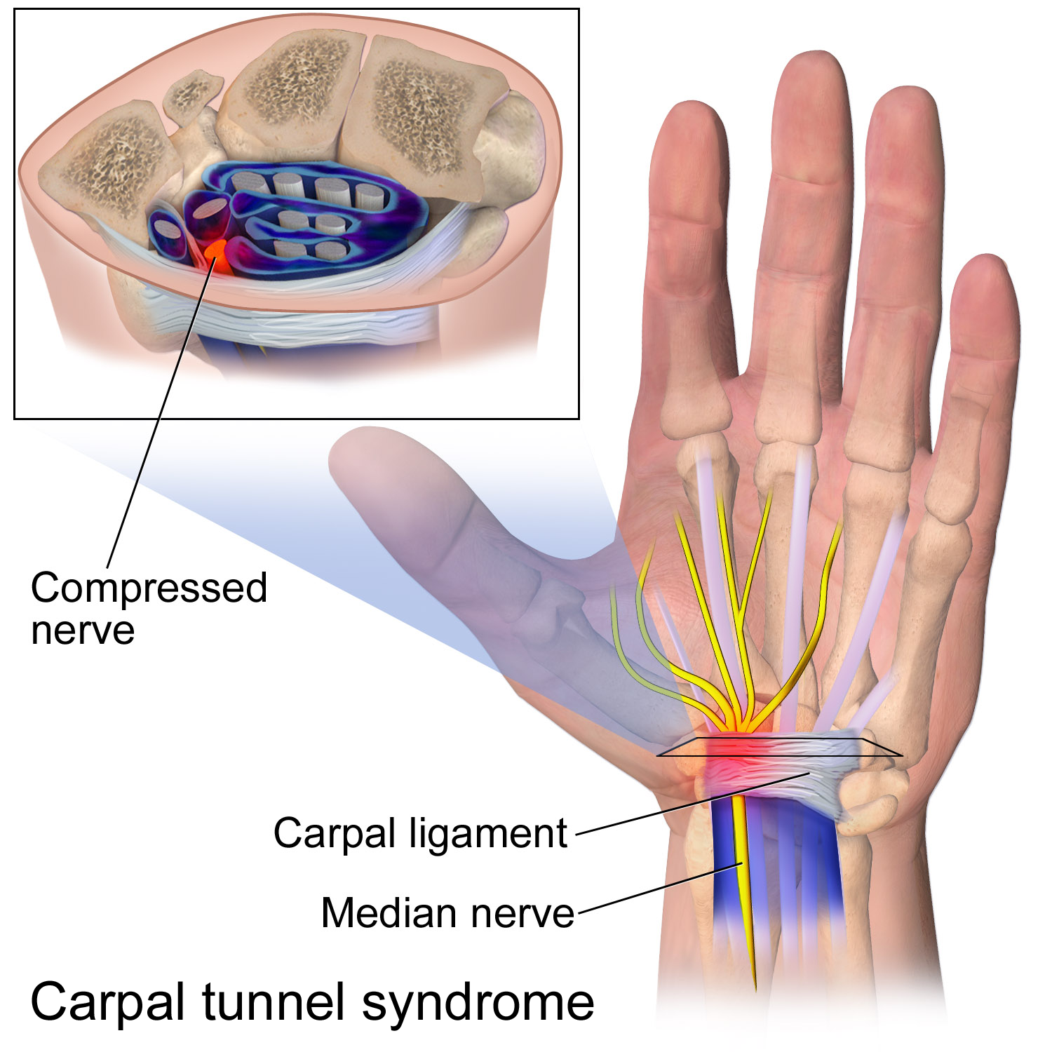 Maintaining neutral wrist alignment prevents compression of the median nerve within the narrow space of the carpal tunnel.