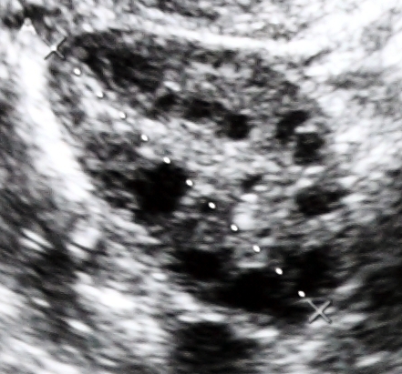 Pelvic ultrasound revealing a polycystic ovary, visually characterized by multiple dark, fluid-filled cysts along the periphery of the ovary.