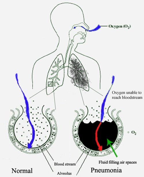 Comparison of a healthy alveolus (left) and one filled with fluid due to pneumonia (right), illustrating the underlying physiological mechanism that generates acoustic crackles during auscultation.