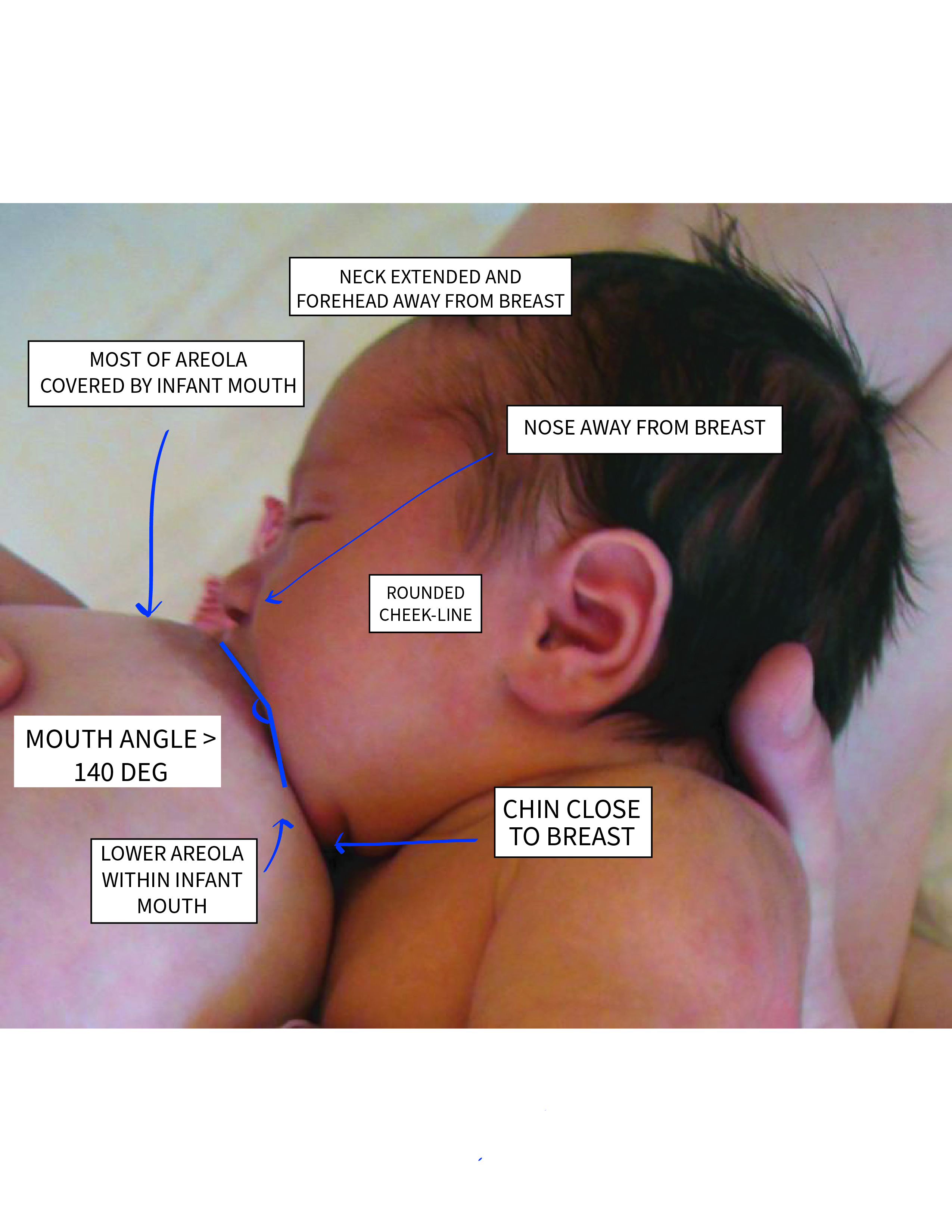 A proper breastfeeding latch is essential; early hunger cues should be addressed before the infant begins crying frantically.