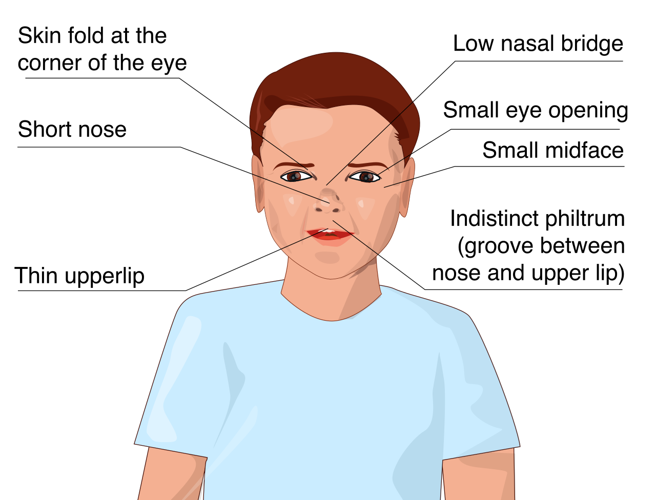 Fetal Alcohol Spectrum Disorders (FASD) are caused by prenatal exposure to teratogens like alcohol and manifest with distinct facial characteristics alongside cognitive and behavioral deficits.