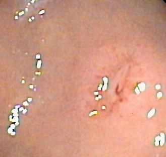 Endoscopic view of a gastric ulcer with a visible blood vessel. NSAIDs are absolutely contraindicated in such clients because they strip away protective stomach prostaglandins and inhibit platelet aggregation, drastically increasing the risk of severe hemorrhage.