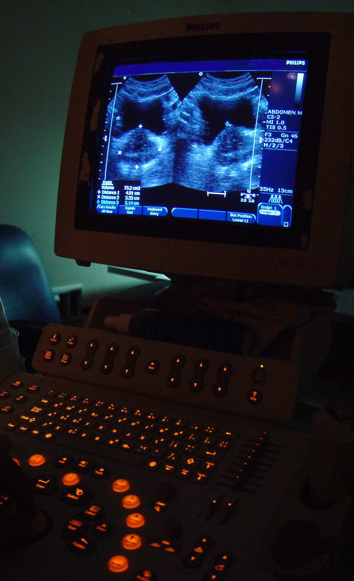 Medical ultrasound visualizing the urinary bladder. Non-invasive bladder scanners utilize this technology to accurately measure post-void residual volumes and diagnose urinary retention.