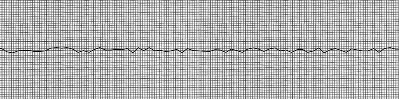 Electrocardiogram tracing of fine ventricular fibrillation, demonstrating the chaotic, uncoordinated electrical activity that prevents effective mechanical pumping.