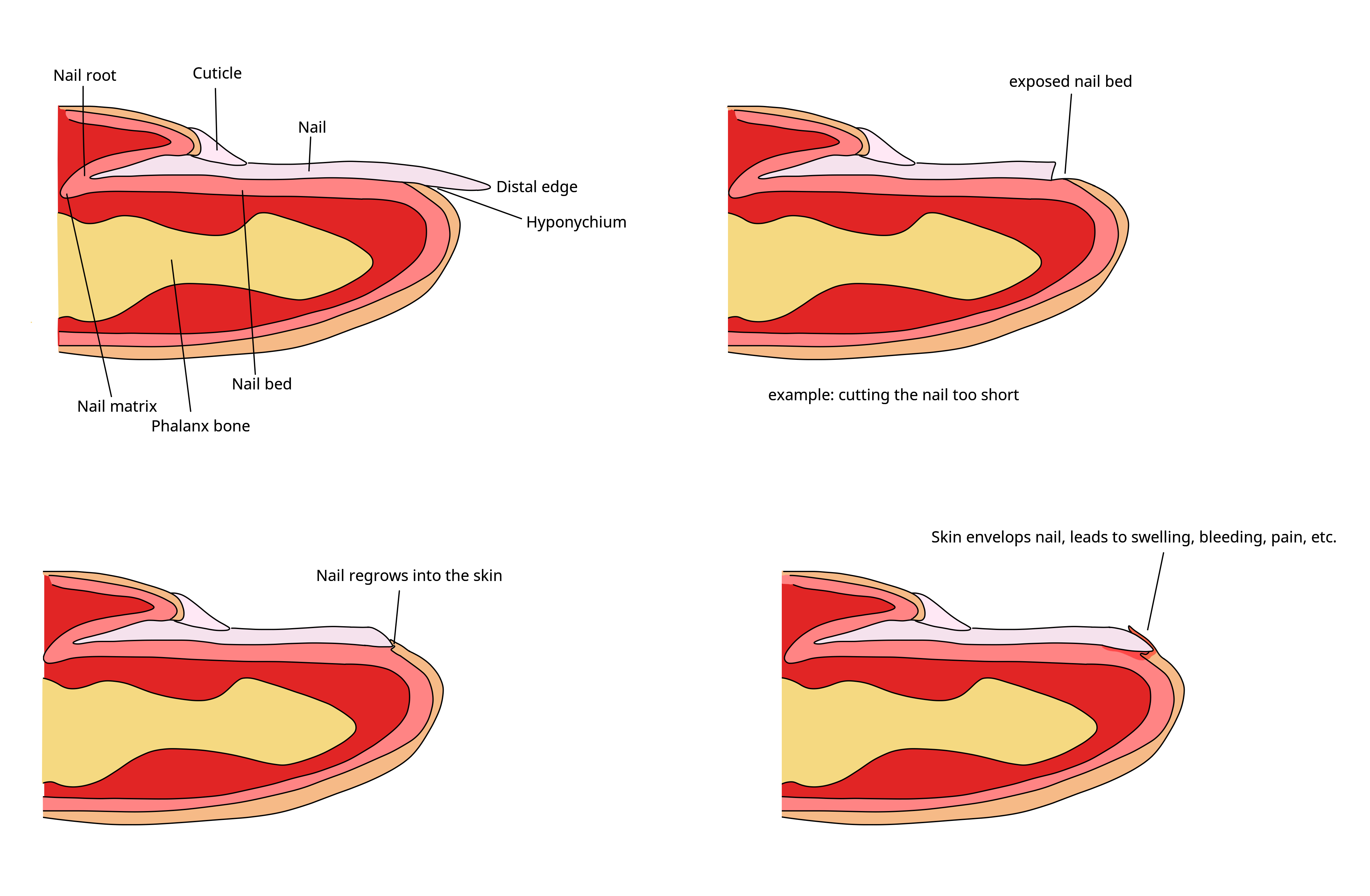 Diagram demonstrating the formation of an ingrown nail. Diabetic patients must file toenails straight across to prevent the nail edge from penetrating the surrounding tissue.