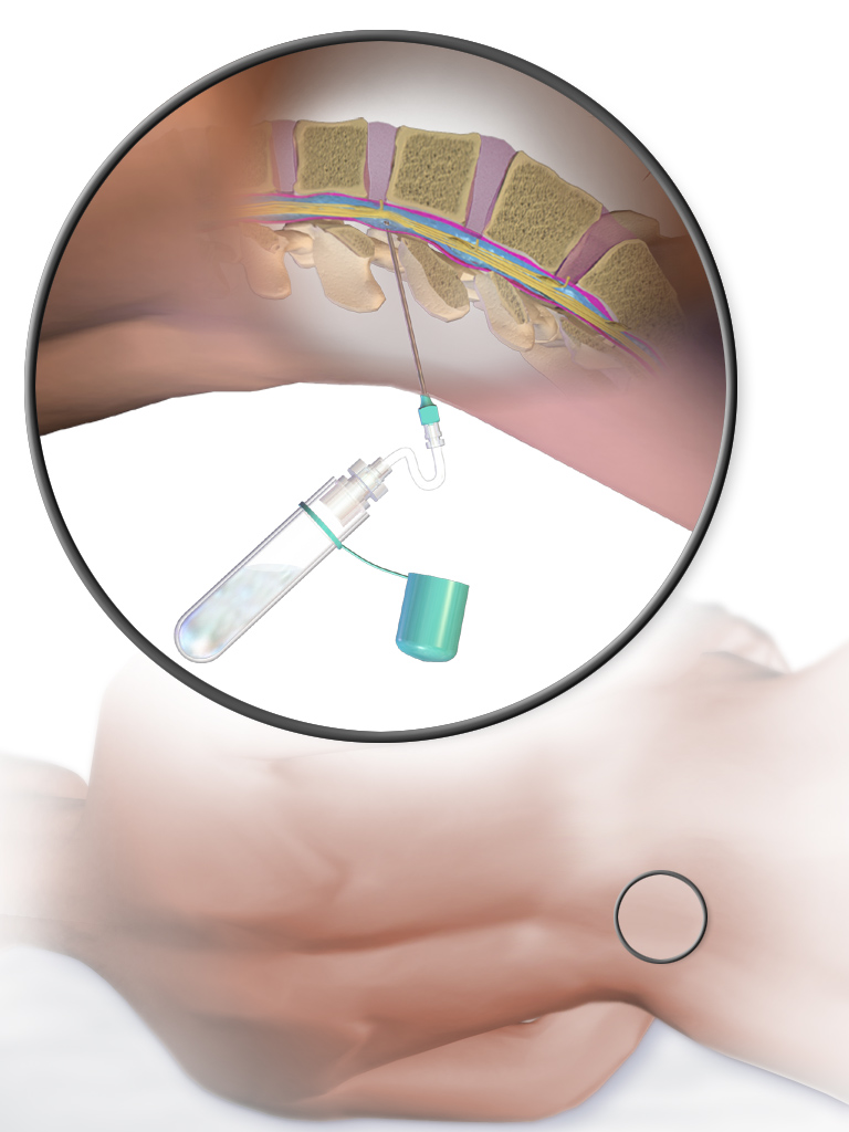 Illustration of a lumbar puncture, demonstrating how a needle is inserted into the pressurized subarachnoid space to access cerebrospinal fluid.