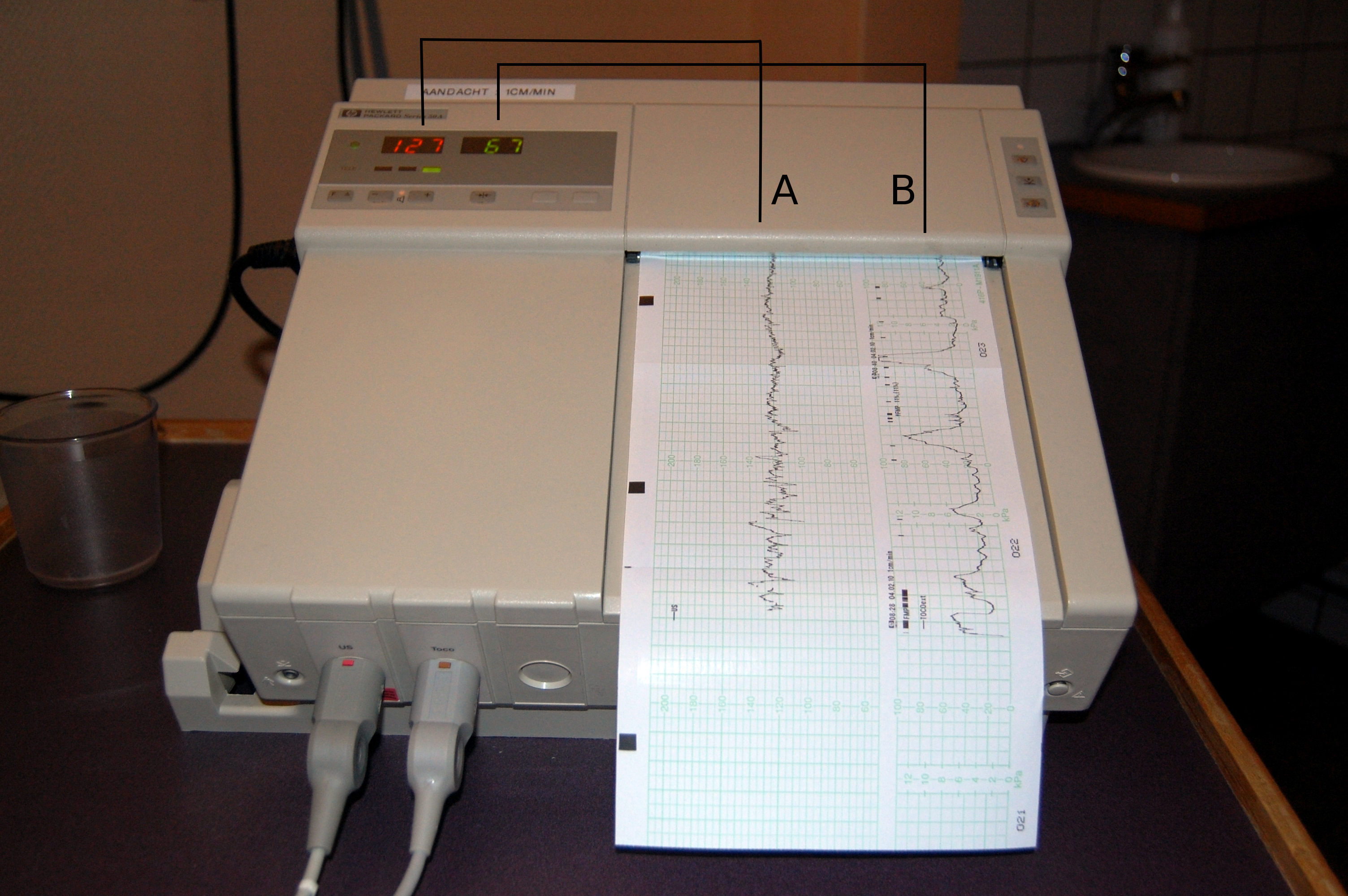 A cardiotocography (CTG) diagram illustrating the simultaneous monitoring of the fetal heart rate (top trace) and maternal uterine contractions (bottom trace).
