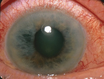 Acute angle-closure glaucoma presents with a hazy cornea and dilated vessels. Anticholinergic medications are strictly contraindicated here as their pupil-dilating effects can increase intraocular pressure and cause blindness.