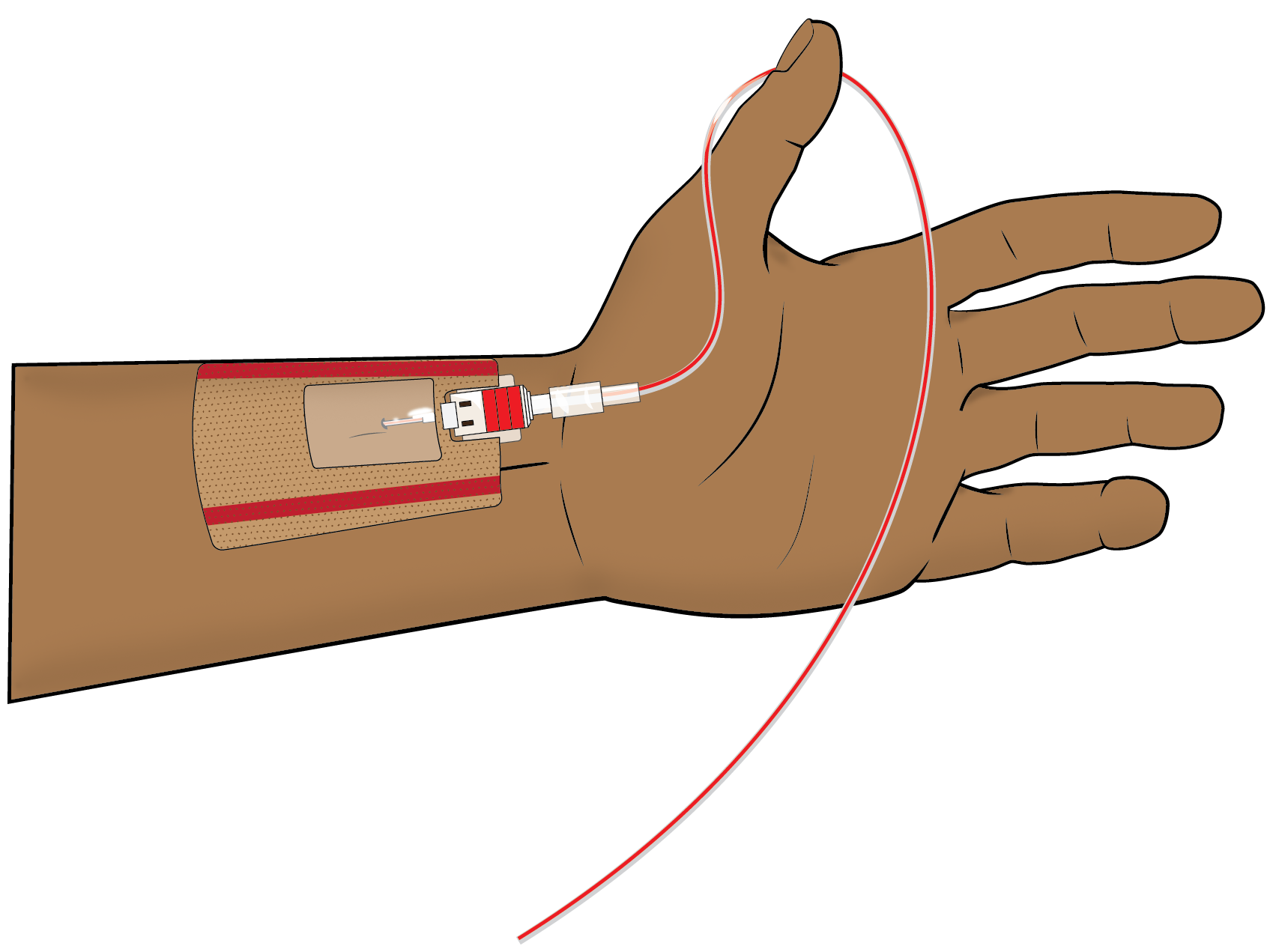 Illustration of an arterial catheter placed in the radial artery. For accurate hemodynamic monitoring, the pressure transducer must be carefully leveled to the patient's phlebostatic axis.