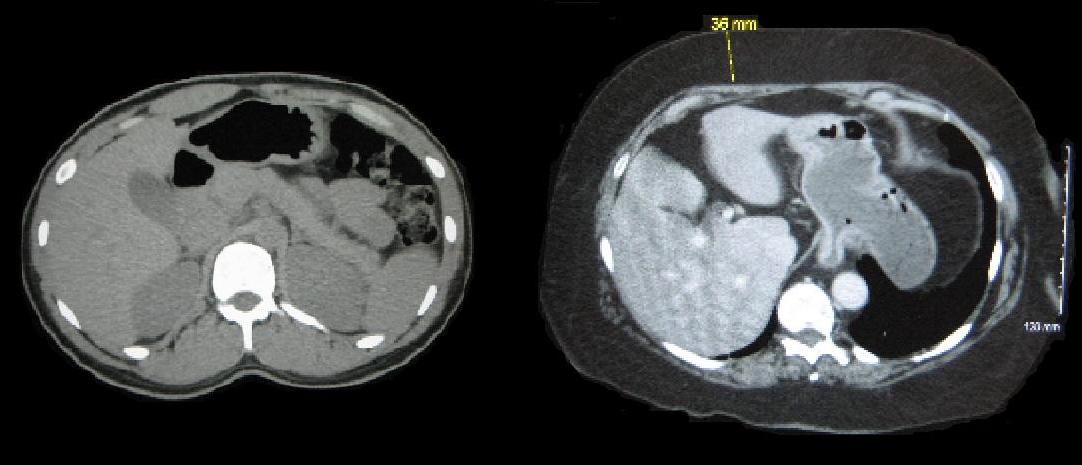 CT scan cross-sections comparing a normal-weight torso (left) and an obese torso (right). The highlighted outer layer demonstrates the hypodermis functioning as a major anatomical reservoir for subcutaneous adipose tissue.