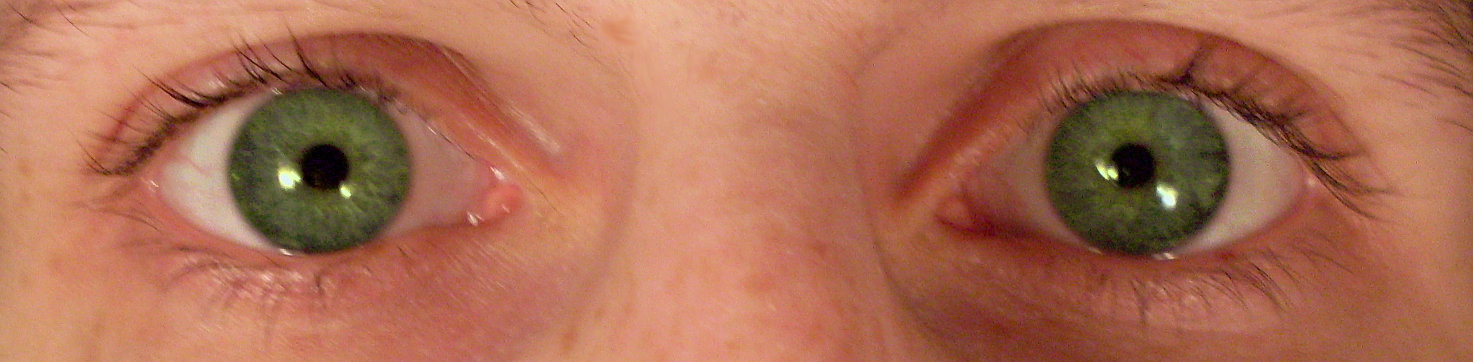 Pinpoint pupils (miosis) are a classic, defining clinical sign of opioid intoxication and potential overdose.
