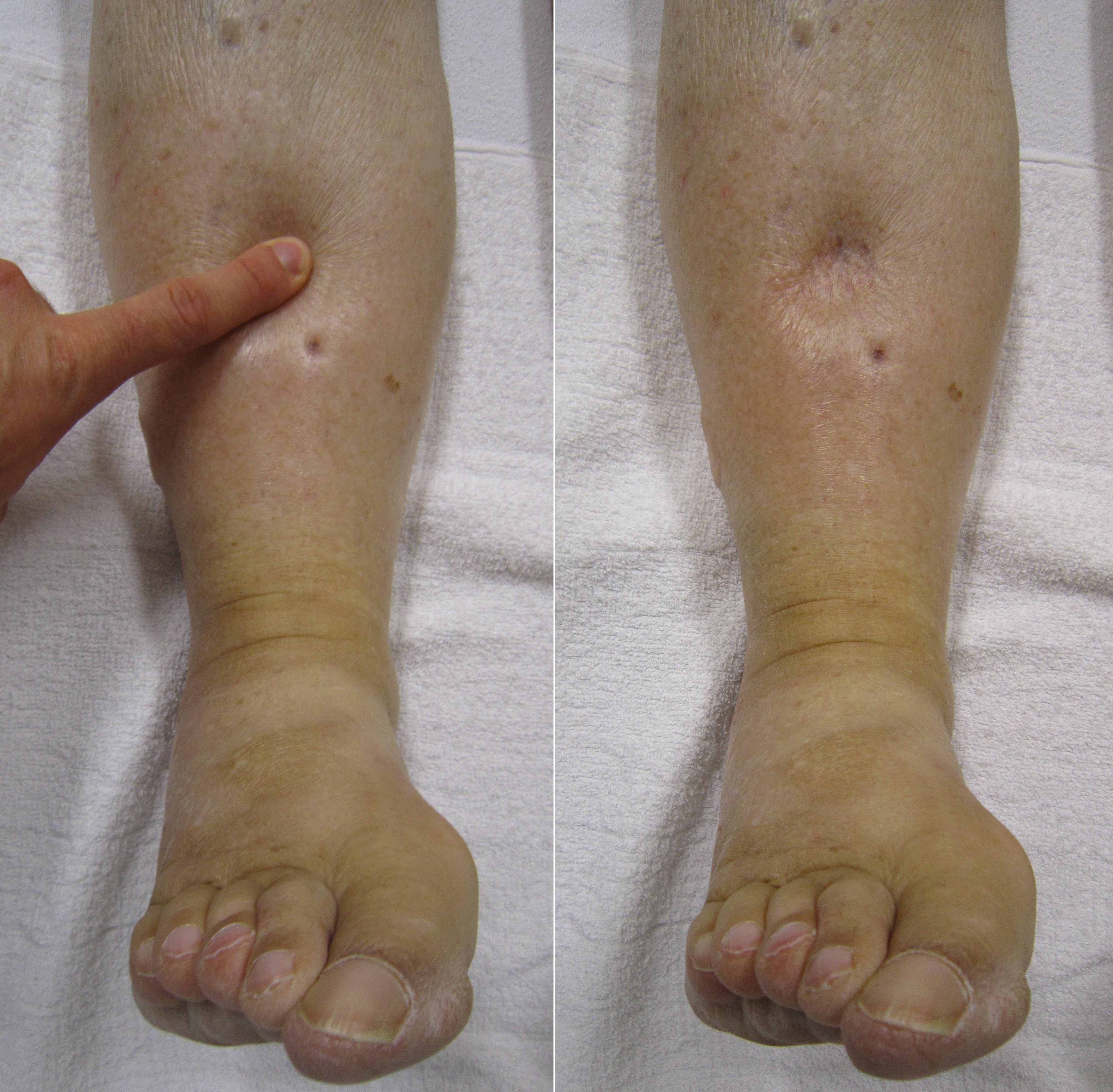 Severe pitting edema in the lower extremities, visually indicating profound fluid shifting into the interstitial spaces, commonly associated with poor peripheral perfusion or heart failure.