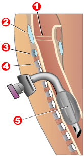 Diagram of a tracheostomy tube inside the trachea, showing the inflatable balloon cuff (5). For a speaking valve to be safely used, this cuff must be fully deflated to allow exhaled air to pass upward through the vocal cords.