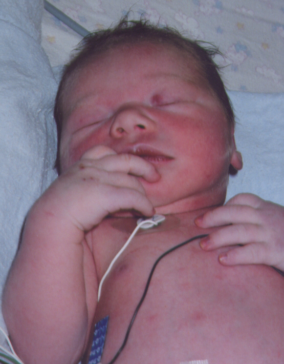 A neonate exhibiting cyanosis in the nailbeds, indicating severe underlying tissue hypoxia that requires immediate respiratory intervention.