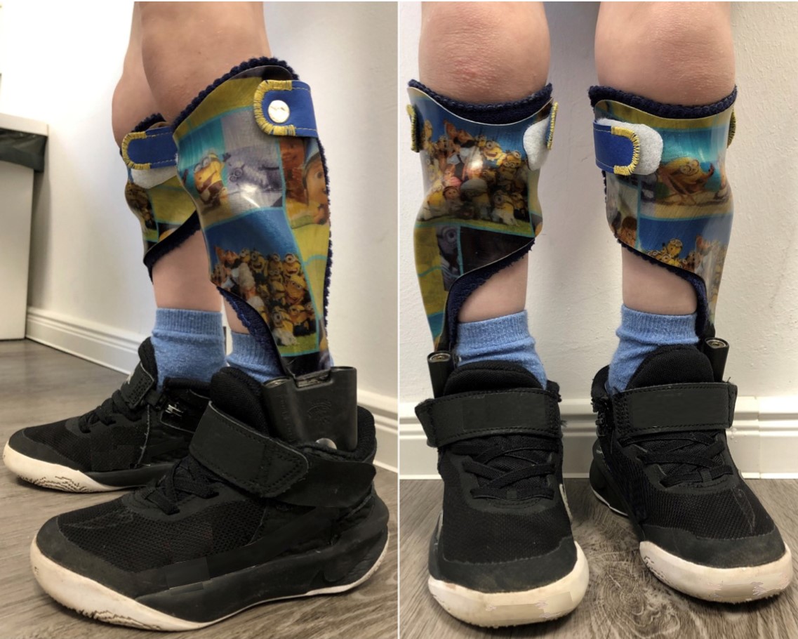 An Orthopedic Impairment like Cerebral Palsy must be severe enough to adversely affect educational performance, often requiring orthotic supports or physical therapy to navigate the school environment.