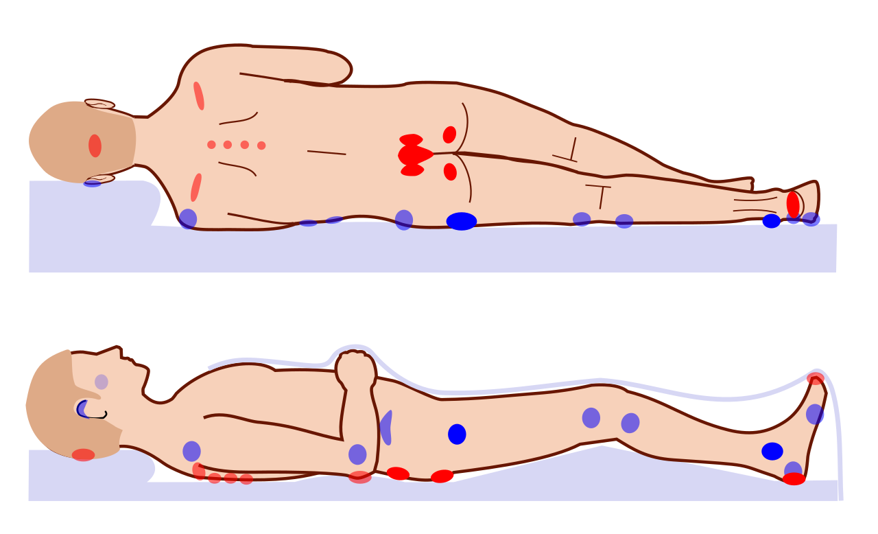 Bony prominences like the sacrum, heels, elbows, and occiput bear the brunt of mechanical pressure in a supine patient, making them highly susceptible to tissue ischemia and pressure injuries.