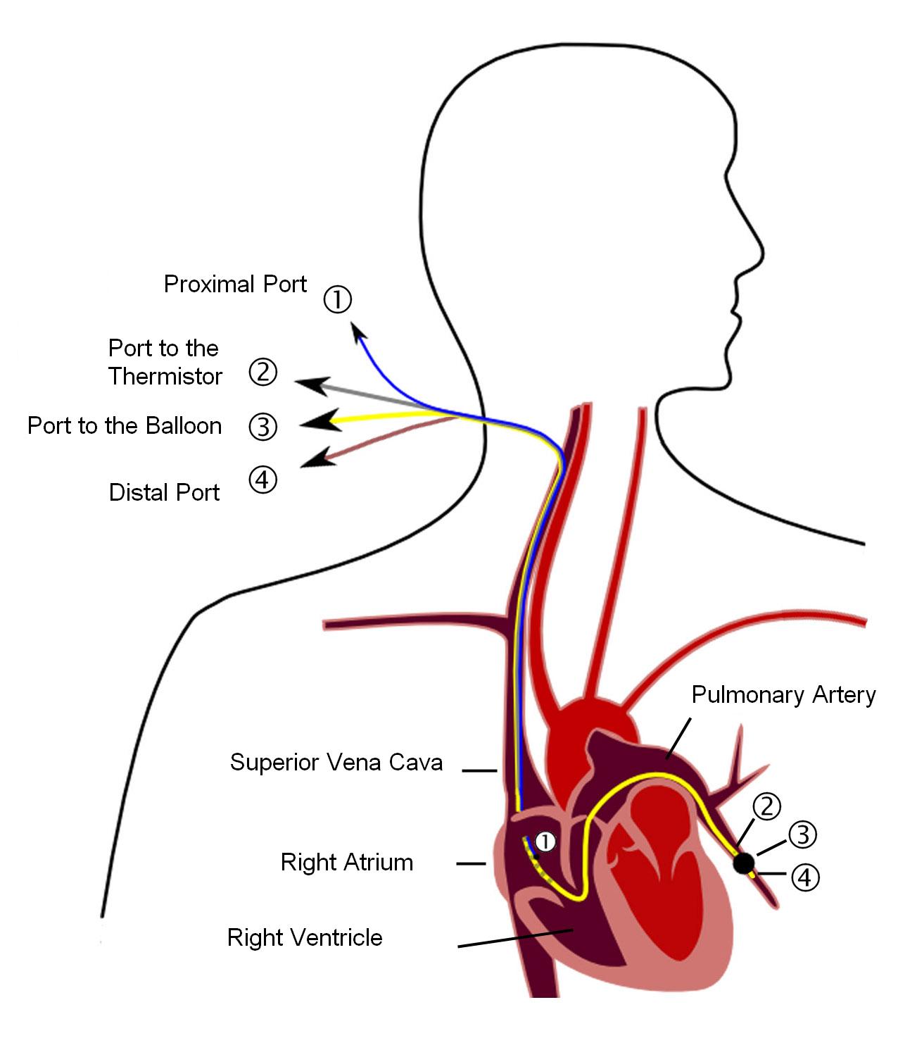 Diagram of a pulmonary artery catheter in position, used to measure right-sided heart pressures and indirectly assess left atrial pressure via the wedge technique.