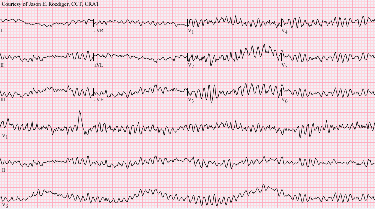 Electrocardiogram (ECG) rhythm strip displaying ventricular fibrillation, a chaotic, non-perfusing electrical state requiring immediate defibrillation.