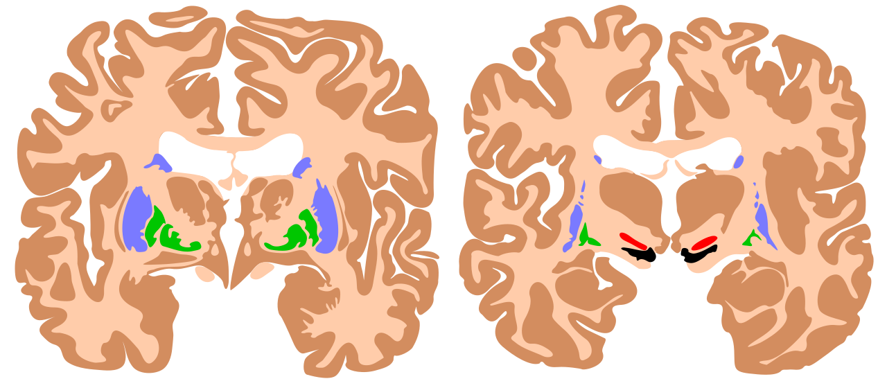 The basal ganglia are deep brain structures involved in movement and impulse regulation, forming the shared neurological pathway for Tourette Syndrome, ADHD, and OCD.