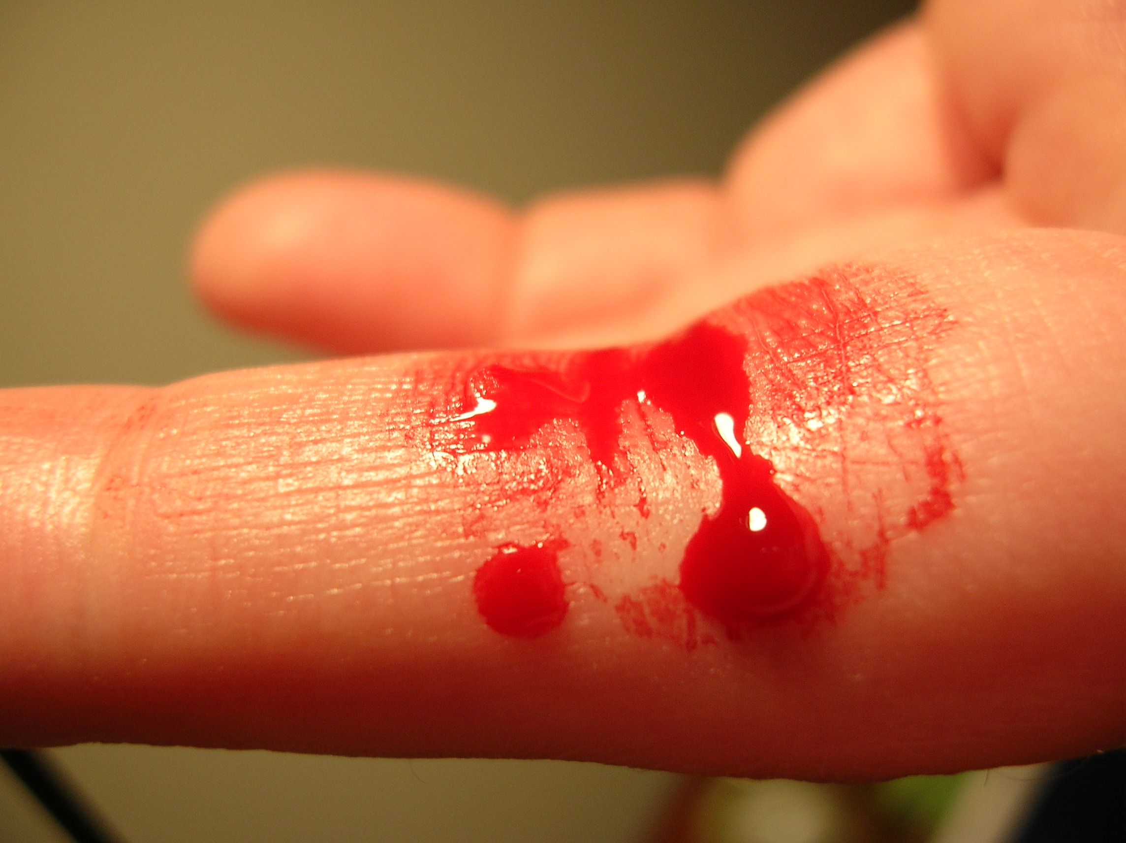 A drop of capillary blood formed after a finger puncture. Selecting the lateral side of the fingertip avoids the dense nerve concentrations in the finger pad, maximizing patient comfort.