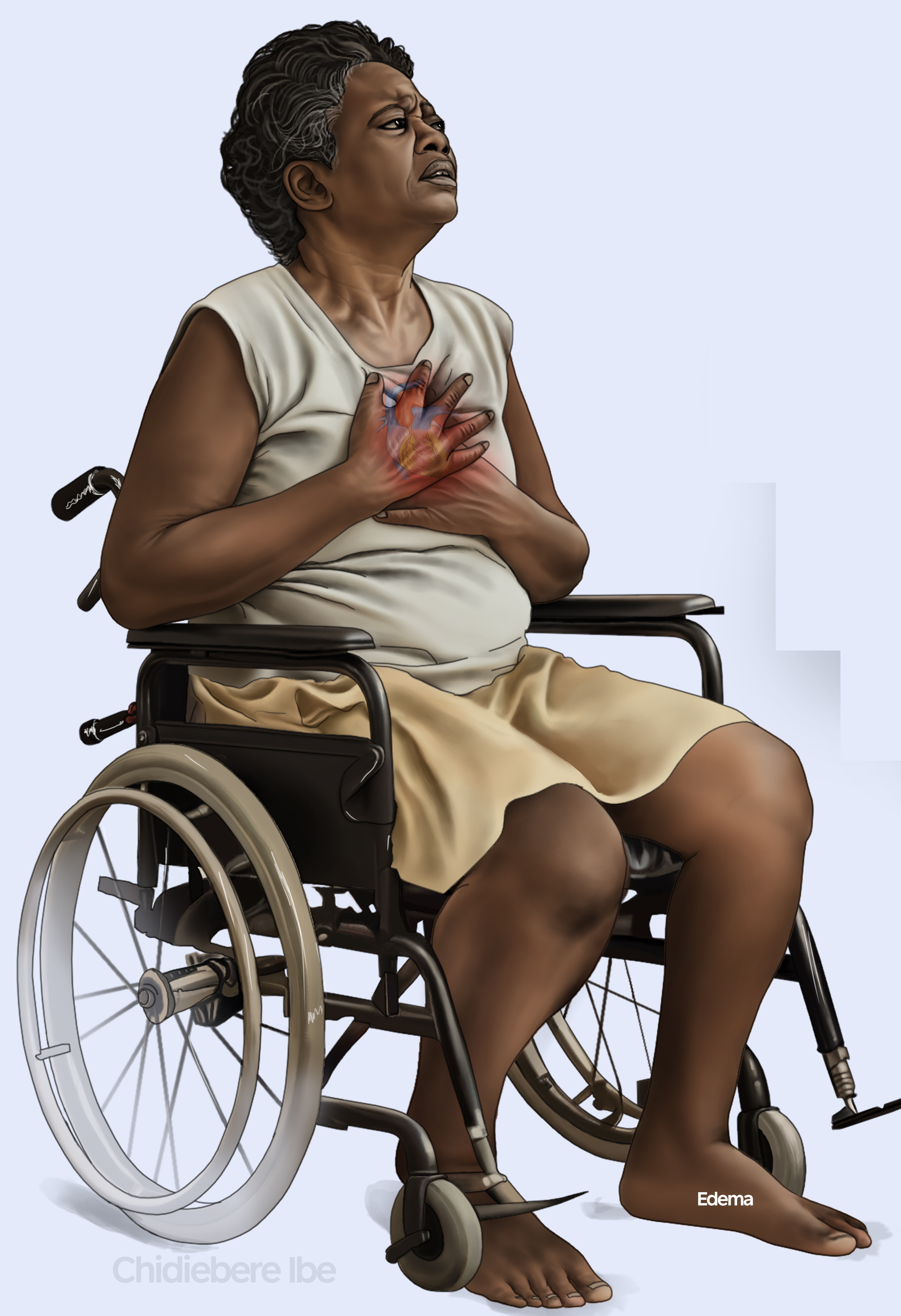 Illustration of a patient experiencing severe chest pain. While chest tightness is a hallmark physical manifestation of grief, the nurse's first priority is to assess the client and immediately rule out a myocardial infarction or other acute cardiac event.