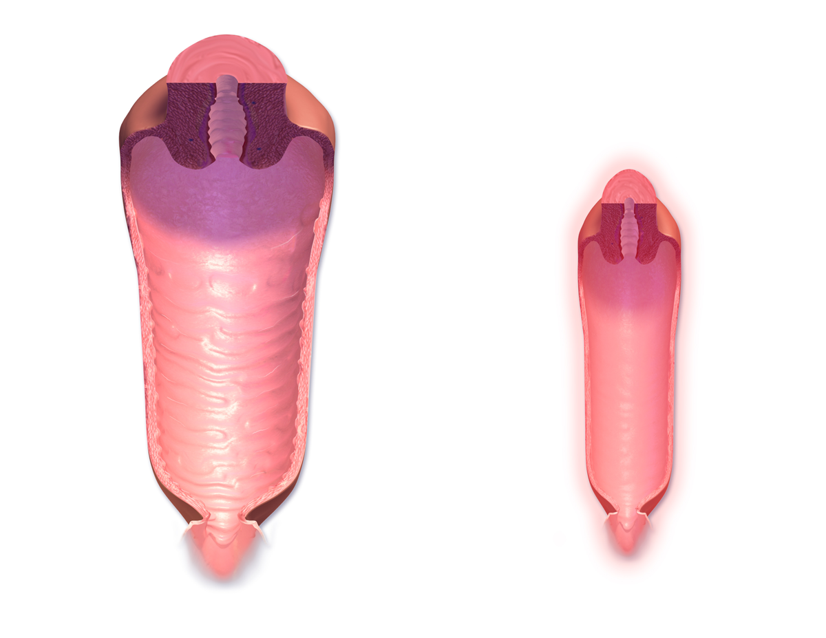 Postmenopausal decreases in estrogen lead to vaginal atrophy and a narrowing of the vaginal canal, frequently causing painful intercourse (dyspareunia) that can be relieved with water-soluble lubricants.